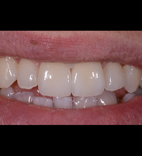 Shelly's Story - Anterior Aesthetics