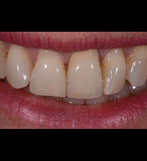 Carol's Story - Anterior Aesthetics