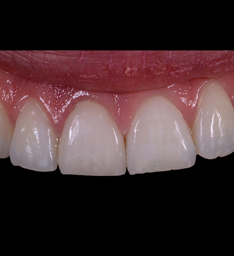 Bianca's Story - Anterior Aesthetics
