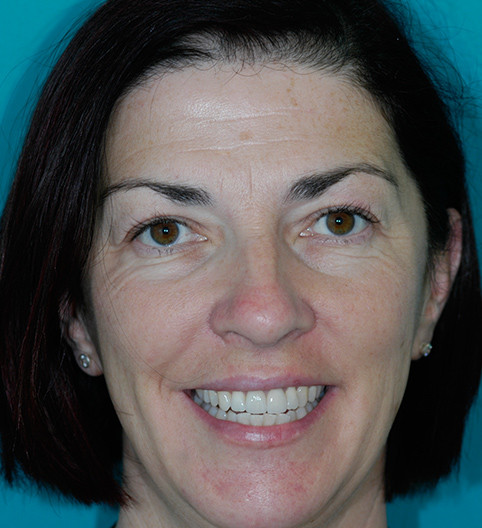 Anne's Story - Anterior Aesthetics