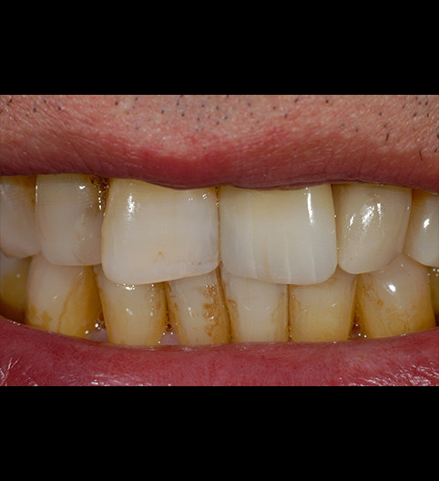 Mike's Story - Anterior Aesthetics