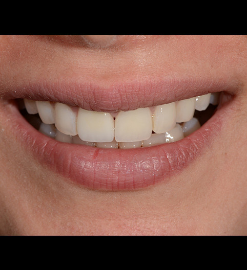 Nazira's Story - Anterior Aesthetics