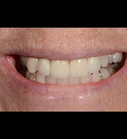 Sue's Story - Anterior Aesthetics