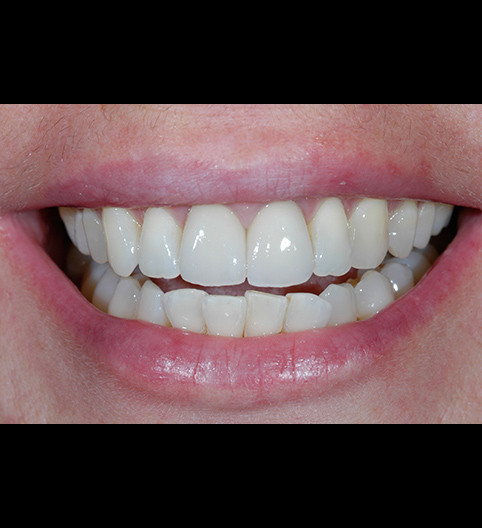 Anne's-Story - Anterior Aesthetics