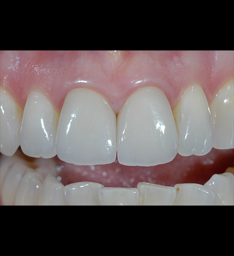 Anne's Story - Anterior Aesthetics