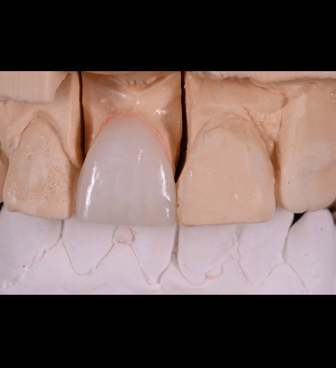 Bianca's Story - Anterior Aesthetics