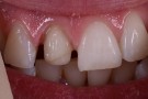 Bianca's Story - Anterior Aesthetics