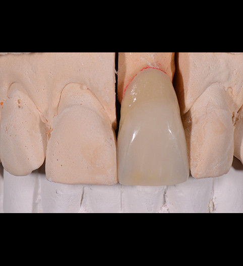 Carol's Story - Anterior Aesthetics