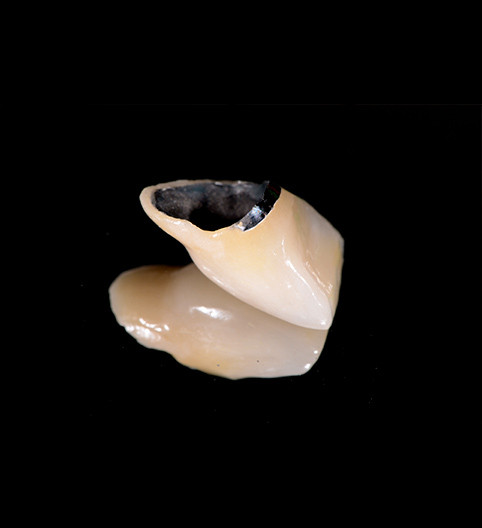 Carol's Story - Anterior Aesthetics