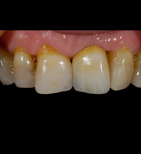 Mike's Story - Anterior Aesthetics