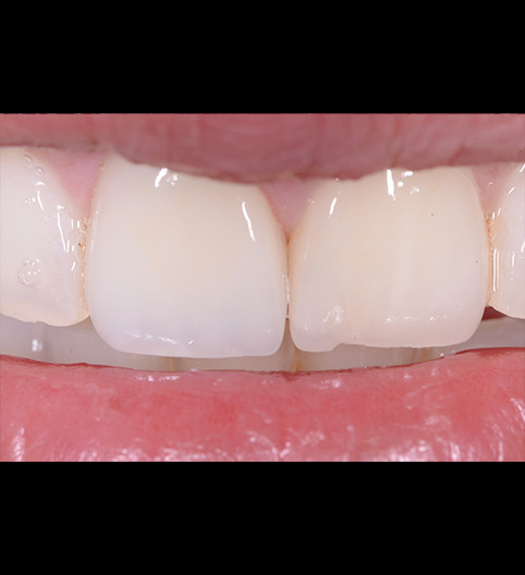 Nazira's Story - Anterior Aesthetics
