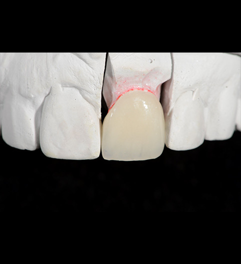 Nazira's Story - Anterior Aesthetics