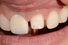 Nazira's Story - Anterior Aesthetics