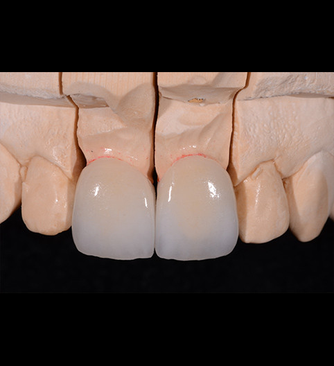 Shelly's Story - Anterior Aesthetics