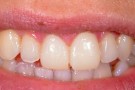 Shelly's Story - Anterior Aesthetics