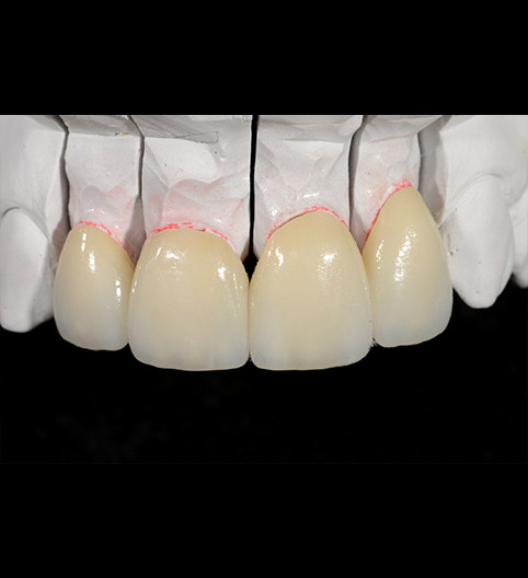 Sue's Story - Anterior Aesthetics