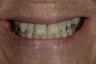 Sue's Story - Anterior Aesthetics