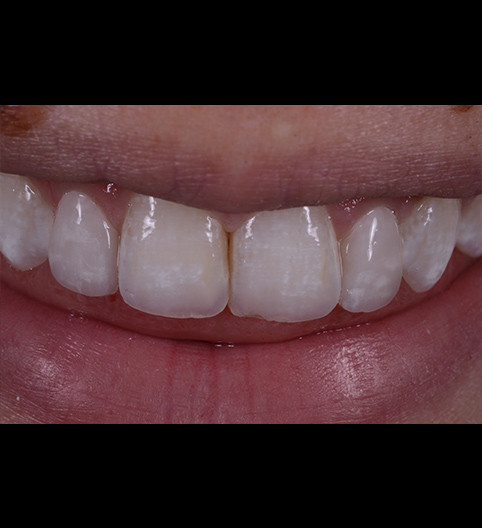 Annabel's Story - Anterior Prepless
