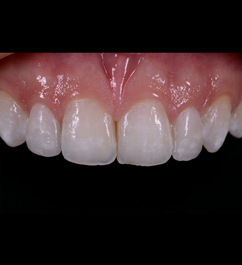 Annabel's Story - Anterior Prepless