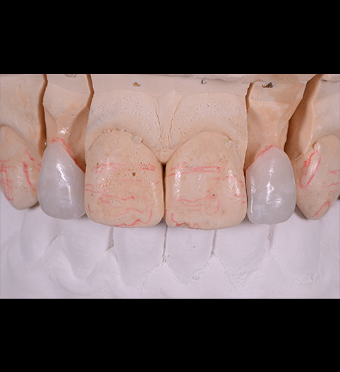 Annabel's Story - Anterior Prepless