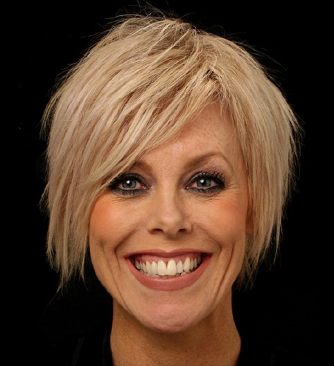 Jacqui's Story - Anterior Prepless