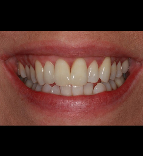 Jacqui's Story - Anterior Prepless Jacqui's Story - Anterior Prepless