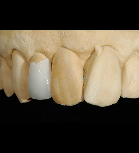 Jacqui's Story - Anterior Prepless Jacqui's Story - Anterior Prepless