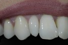 Jacqui's Story - Anterior Prepless