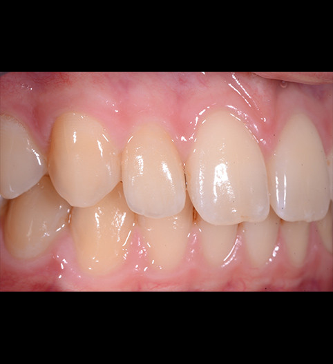 Oliver's Story - Anterior Prepless