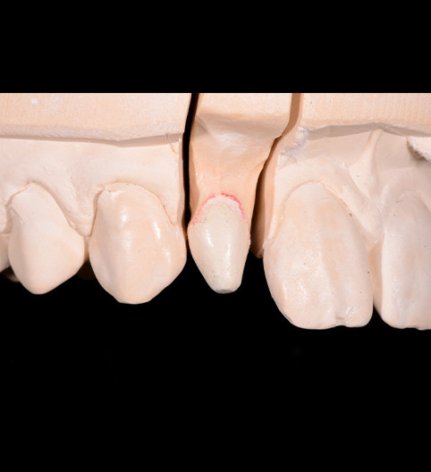 Oliver's Story - Anterior Prepless