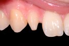 Oliver's Story - Anterior Prepless