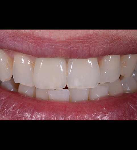 Scott's Story - Anterior Prepless