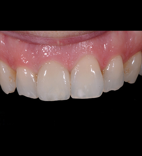 Scott's Story - Anterior Prepless