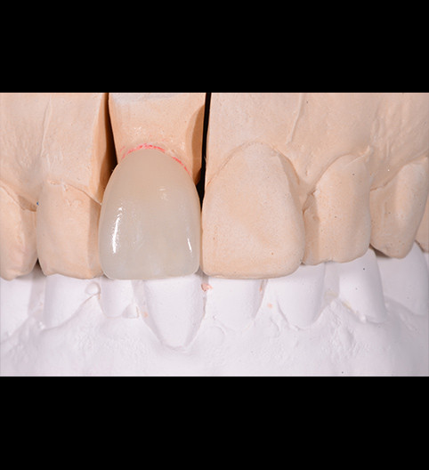 Scott's Story - Anterior Prepless