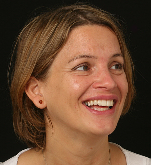 Xenia's Story - Anterior Prepless