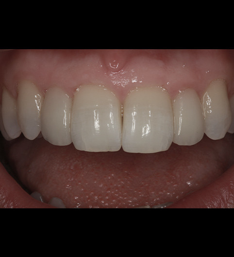 Xenia's Story - Anterior Prepless
