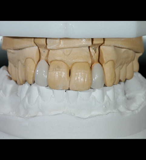 Xenia's Story - Anterior Prepless