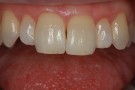 Xenia's Story - Anterior Prepless