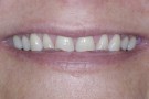 Claire's Story - Cosmetic Dentistry