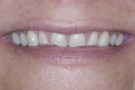 Claire's Story - Cosmetic Dentistry
