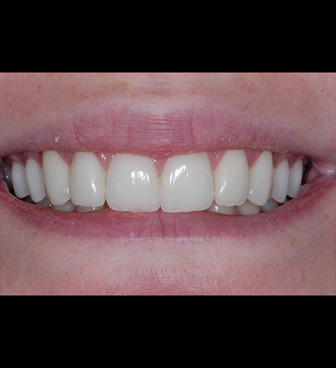 Hayley's Story - Cosmetic Dentistry