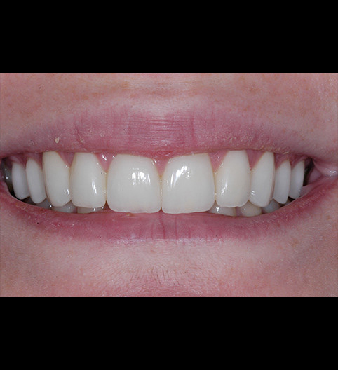 Hayley's Story - Cosmetic Dentistry Hayley's Story - Cosmetic Dentistry