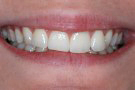 Hayley's Story - Cosmetic Dentistry