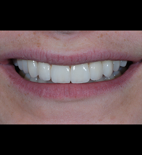 Hollie's Story - Cosmetic Dentistry