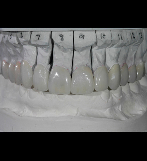 Hollie's Story - Cosmetic Dentistry