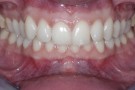 Hollie's Story - Cosmetic Dentistry