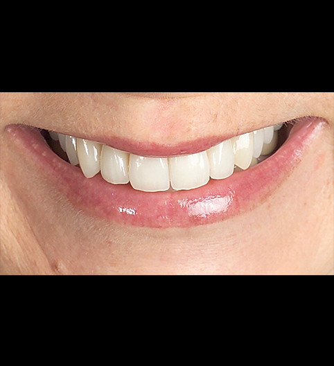 Jenny's Story - Cosmetic Dentistry