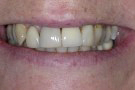 Jenny's Story - Cosmetic Dentistry