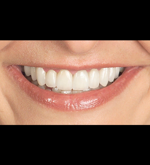 Lenka's Story - Cosmetic Dentistry