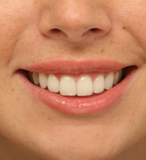 Martine's Story - Cosmetic Dentistry